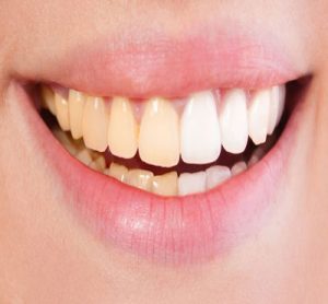 دلایل  زرد شدن دندان  - زرد شدن دندان  